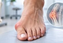 Hallux Valgus